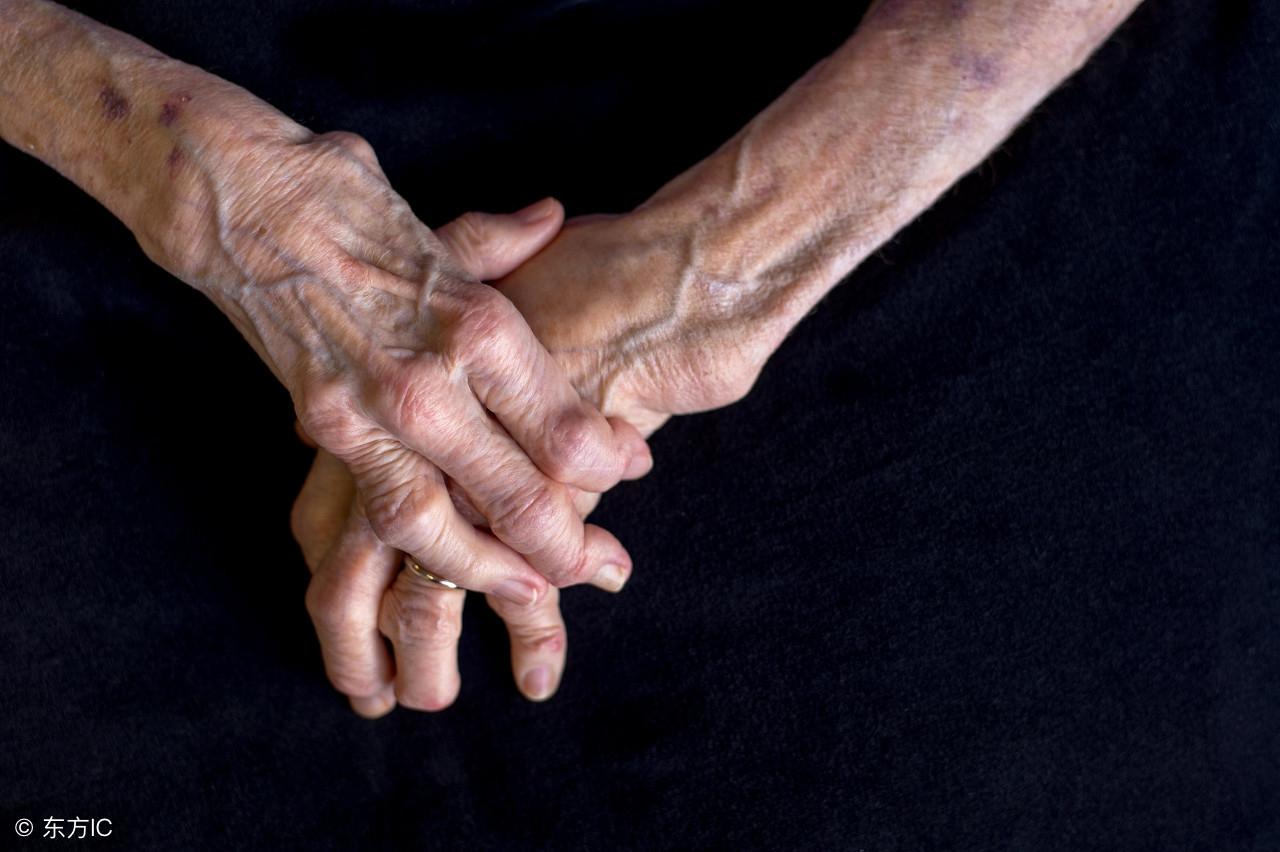 手部老年斑是什么原因 手上长老年斑怎么办